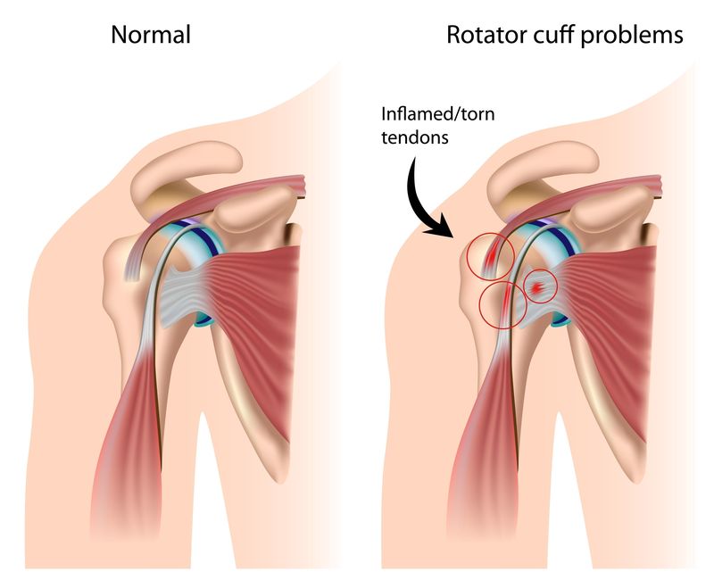 Will a rotator cuff tear heal itself cheap